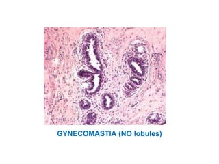 GYNECOMASTIA (NO lobules)
 