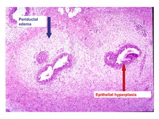 Periductal
edema
Epithelial hyperplasia
 