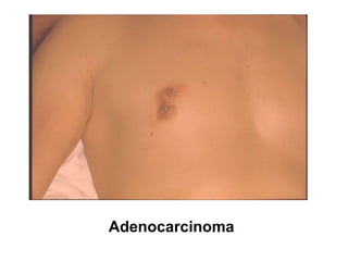 Breast carcinoma march 22. 2015