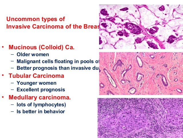 Breast Carcinoma March 22 2015