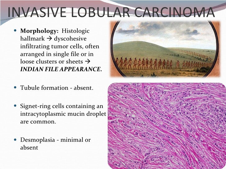 Breast carcinoma pathology