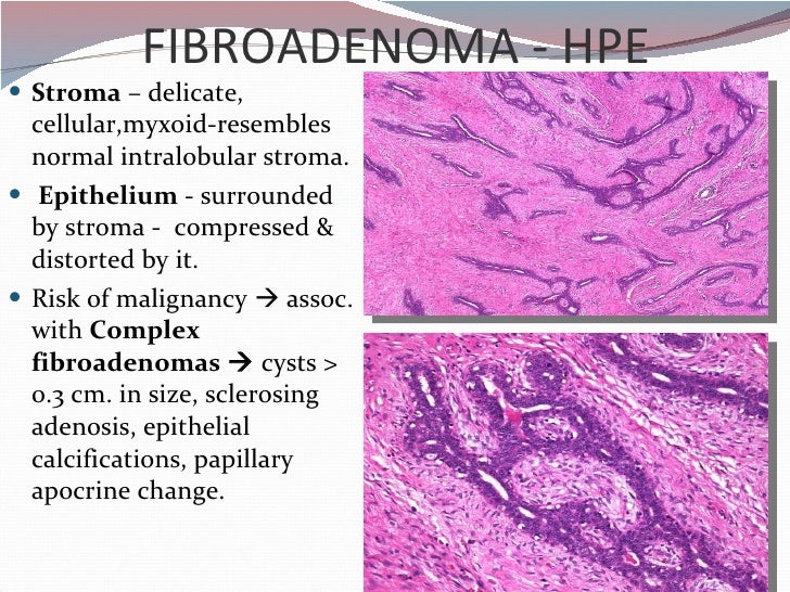 fibroadenoma of breast
