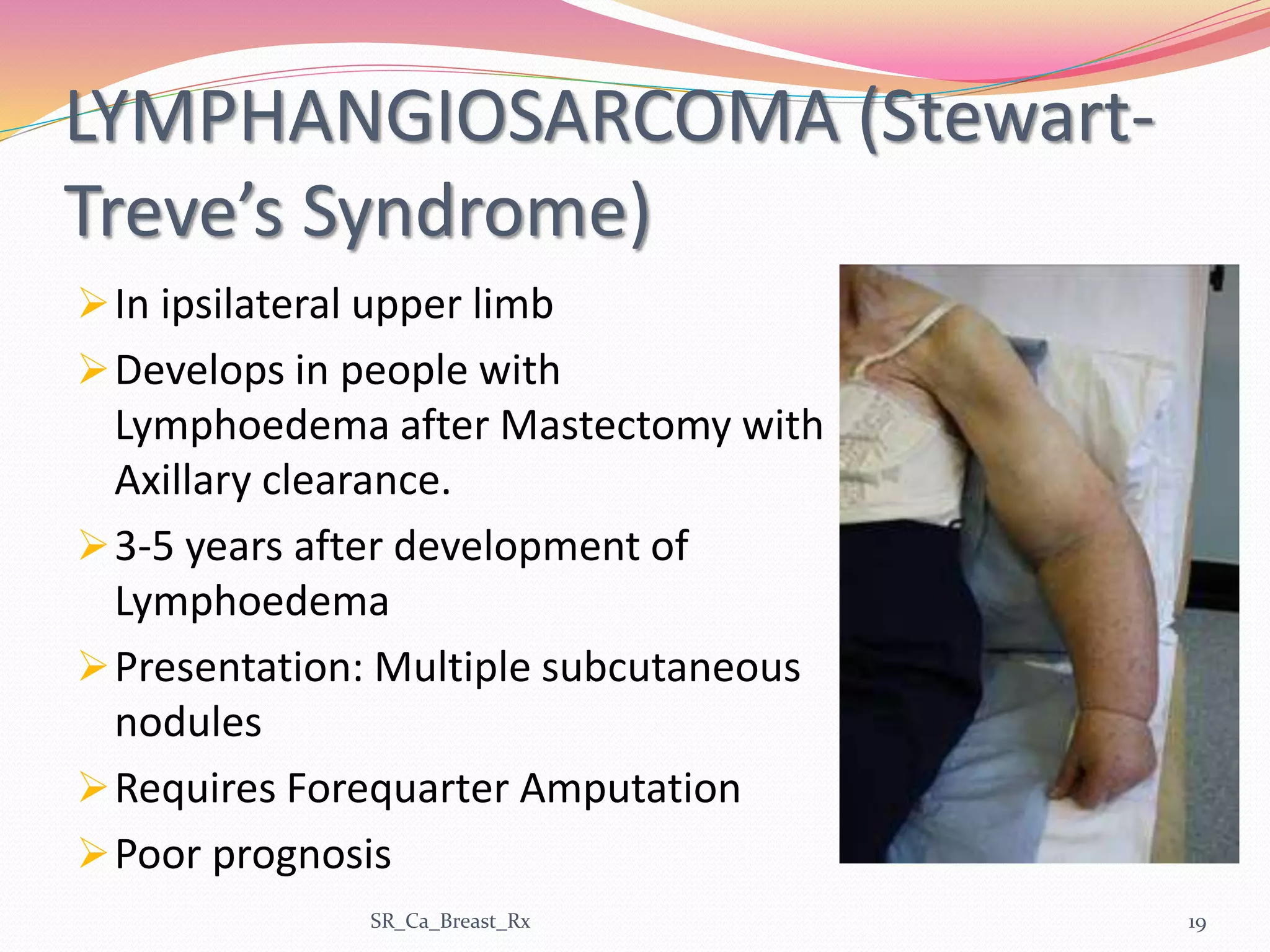 LYMPHANGIOSARCOMA (Stewart-
Treve’s Syndrome)
In ipsilateral upper limb
Develops in people with
Lymphoedema after Mastectomy with
Axillary clearance.
3-5 years after development of
Lymphoedema
Presentation: Multiple subcutaneous
nodules
Requires Forequarter Amputation
Poor prognosis
SR_Ca_Breast_Rx 19
 