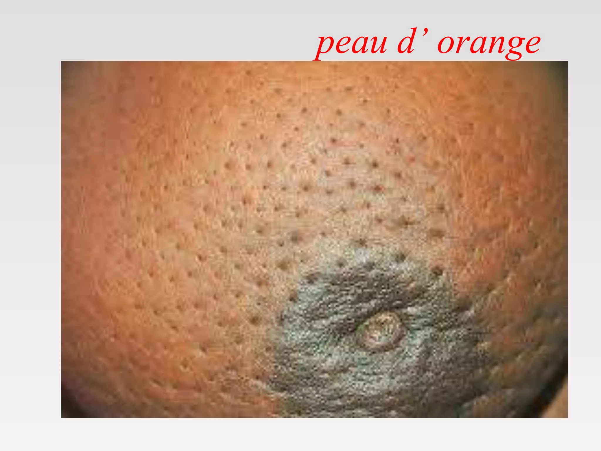 Peau d'orange inflammatory breast cancer visuals Contraindications & When to Consult a Doctor