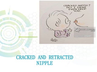 CRACKED AND RETRACTED
NIPPLE
 