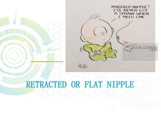 RETRACTED OR FLAT NIPPLE
 