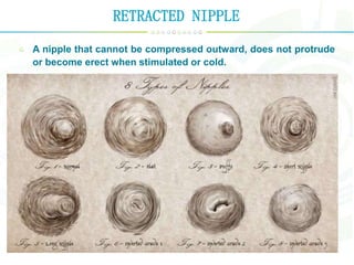 RETRACTED NIPPLE
A nipple that cannot be compressed outward, does not protrude
or become erect when stimulated or cold.
 
