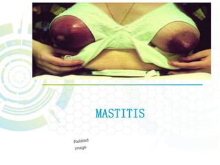 MASTITIS
 