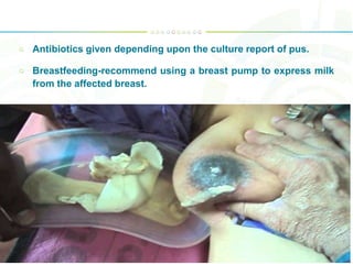 Antibiotics given depending upon the culture report of pus.
Breastfeeding-recommend using a breast pump to express milk
from the affected breast.
 