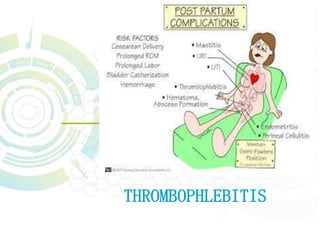 THROMBOPHLEBITIS
 