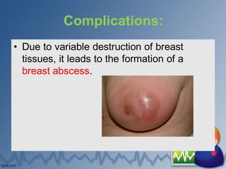 Complications:
• Due to variable destruction of breast
tissues, it leads to the formation of a
breast abscess.
 