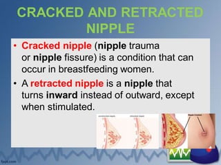 CRACKED AND RETRACTED
NIPPLE
• Cracked nipple (nipple trauma
or nipple fissure) is a condition that can
occur in breastfeeding women.
• A retracted nipple is a nipple that
turns inward instead of outward, except
when stimulated.
 