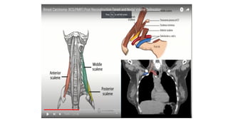 target delineation for breast and axillary nodes contouring.pptx