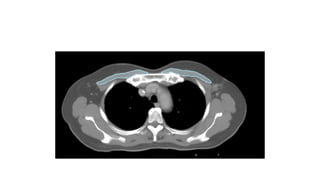 target delineation for breast and axillary nodes contouring.pptx