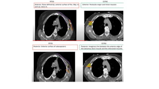 target delineation for breast and axillary nodes contouring.pptx