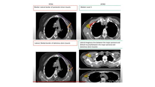 target delineation for breast and axillary nodes contouring.pptx