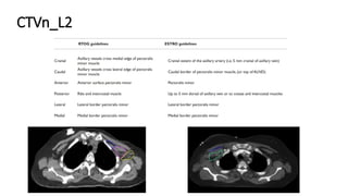 target delineation for breast and axillary nodes contouring.pptx