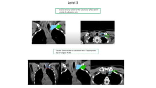 target delineation for breast and axillary nodes contouring.pptx