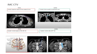 target delineation for breast and axillary nodes contouring.pptx