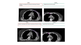 target delineation for breast and axillary nodes contouring.pptx