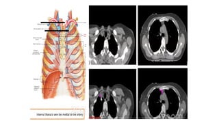 target delineation for breast and axillary nodes contouring.pptx