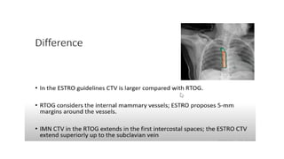 target delineation for breast and axillary nodes contouring.pptx