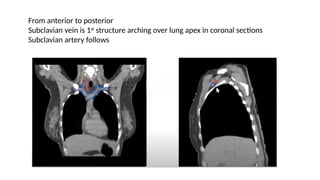 target delineation for breast and axillary nodes contouring.pptx