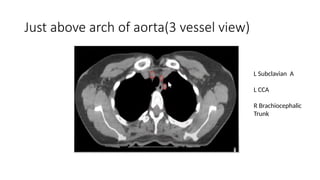 target delineation for breast and axillary nodes contouring.pptx
