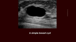 Breast cyst imaging