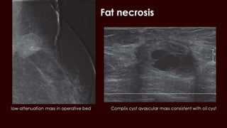 Breast cyst imaging