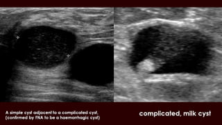 Breast cyst imaging