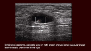 Breast cyst imaging