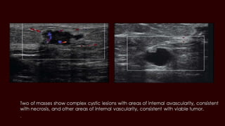 Breast cyst imaging