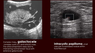 Breast cyst imaging