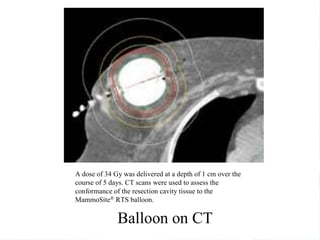 A dose of 34 Gy was delivered at a depth of 1 cm over the
course of 5 days. CT scans were used to assess the
conformance of the resection cavity tissue to the
MammoSite® RTS balloon.

              Balloon on CT
 
