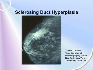 Sclerosing Duct Hyperplasia




                     Tabar L, Dean P.
                     Teaching atlas of
                     mammography. 2nd ed.
                     New York, New York:
                     Thieme Inc. 1985:106
 