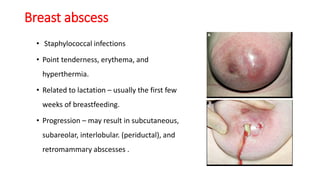 Breast disorders | PPTX