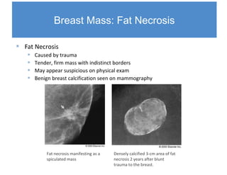 Breast Disorders2 8 11 PPT breast-disorders2-8-11-ppt
