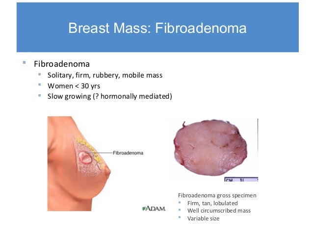 fibroadenoma breastfeeding