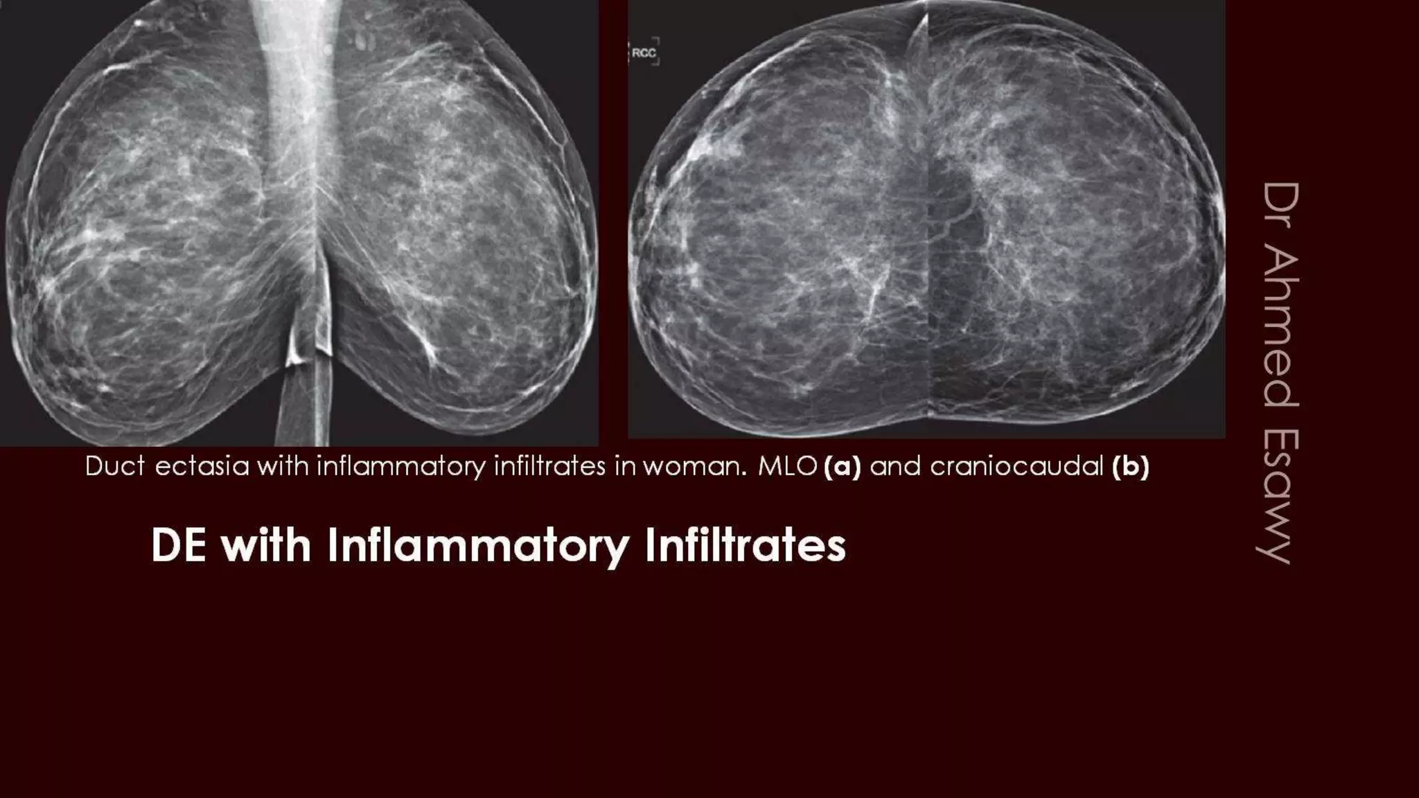Breast Duct Ectasia Us Mammogram Mri PPTX breast-duct-ectasia-us-mammogram-mri-pptx