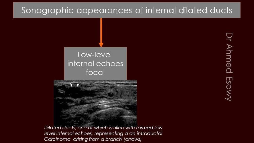 Breast duct ectasia us mammogram mri
