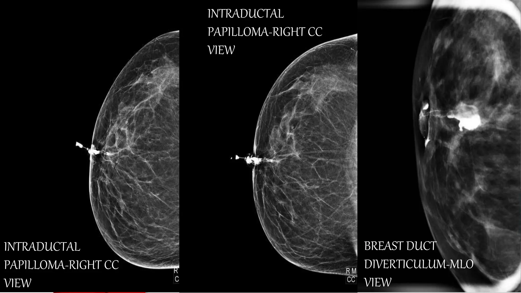 Dactography Types Breast Ductography.pptx