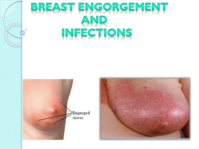 Breastengorgement 130621100349 Phpapp02