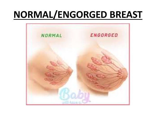 Breast Engorgement