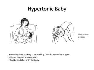 Hypertonic Baby
•Non Rhythmic sucking : Use Rocking chair &
• Breast in quiet atmosphere
•Cuddle and chat with the baby
extra chin support
 