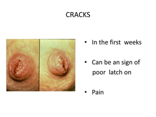 CRACKS
• In the first weeks
• Can be an sign of
poor latch on
• Pain
 