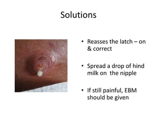 Solutions
• Reasses the latch – on
& correct
• Spread a drop of hind
milk on the nipple
• If still painful, EBM
should be given
 