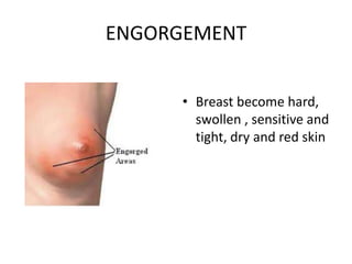 ENGORGEMENT
• Breast become hard,
swollen , sensitive and
tight, dry and red skin
 