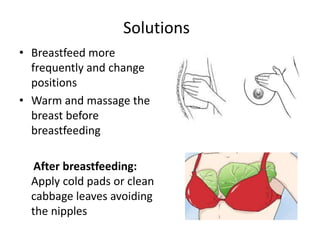 • Breastfeed more
frequently and change
positions
• Warm and massage the
breast before
breastfeeding
After breastfeeding:
Apply cold pads or clean
cabbage leaves avoiding
the nipples
Solutions
 