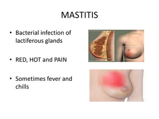 MASTITIS
• Bacterial infection of
lactiferous glands
• RED, HOT and PAIN
• Sometimes fever and
chills
 